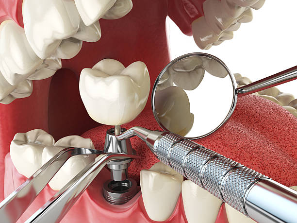 Best Emergency Dental Filling Replacement  in Forestville, CA